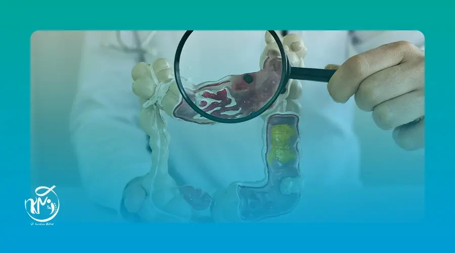  اعراض اورام القولون