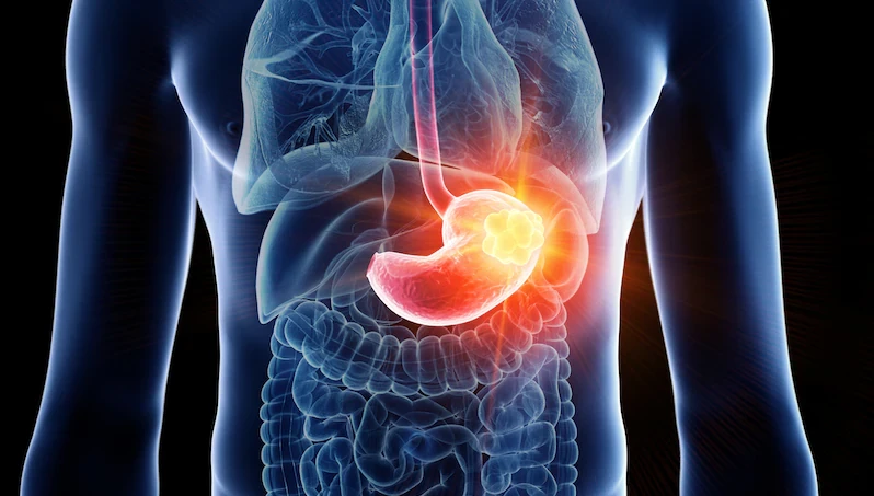 أورام الرأس والرقبة